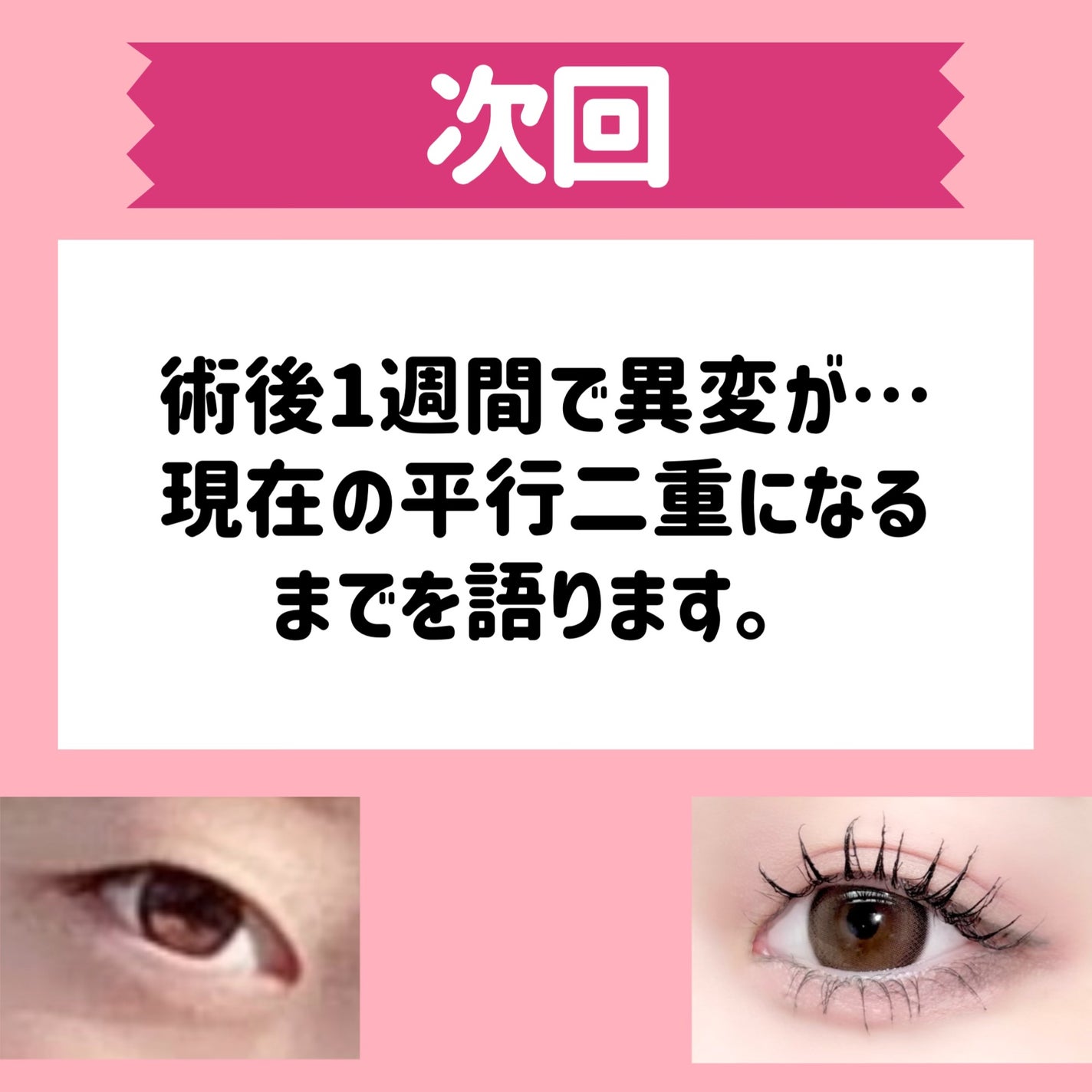 五月@正直レビュー on LIPS 「【水の森で二重埋没した結果📖】カウンセリング予約~術後まで全て..」(10枚目)