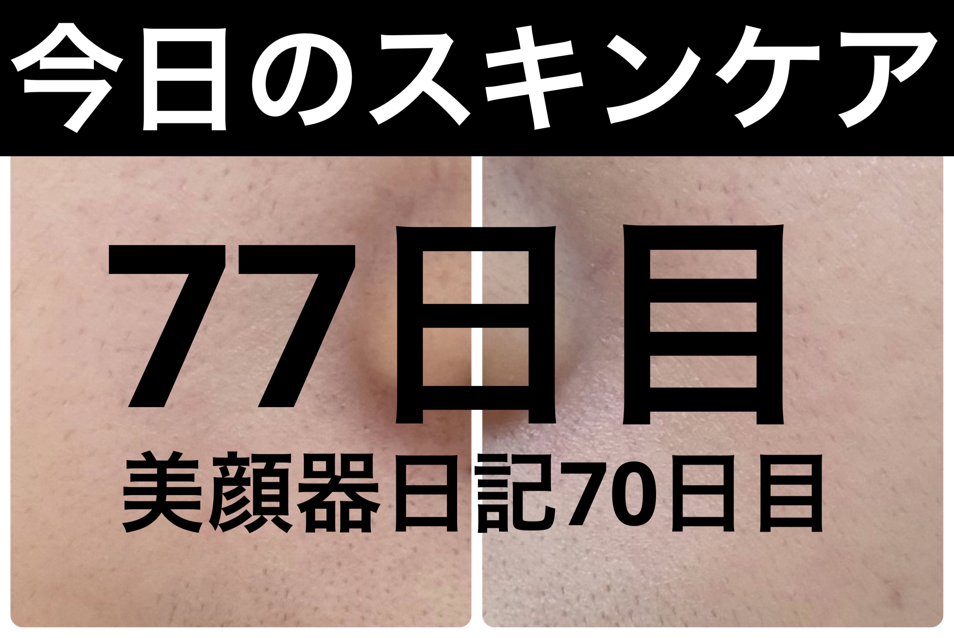 AGE-R ブースタープロ/MEDICUBE/美顔器・マッサージを使ったクチコミ（1枚目）