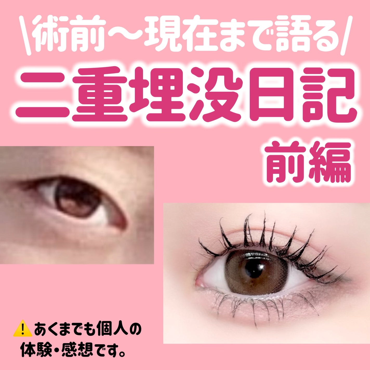 五月@正直レビュー on LIPS 「【水の森で二重埋没した結果📖】カウンセリング予約~術後まで全て..」(1枚目)