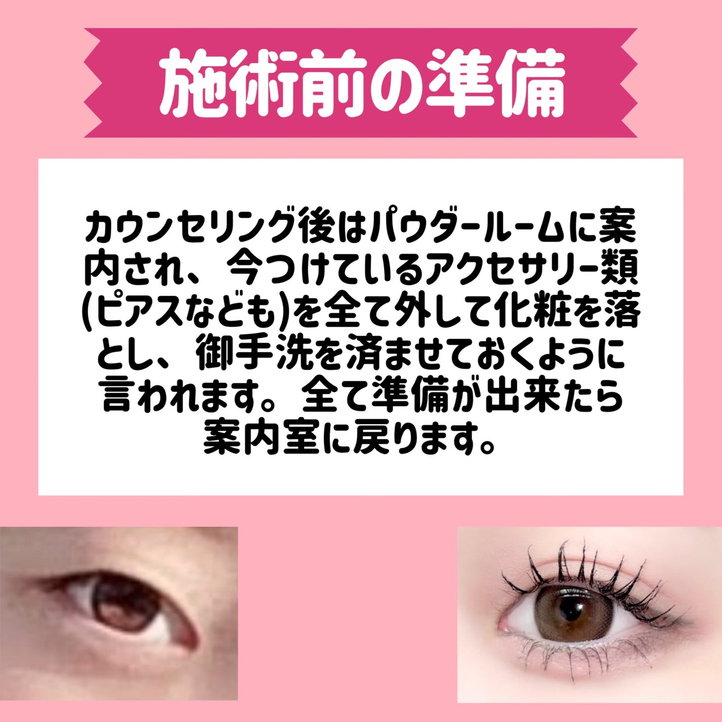 五月@正直レビュー on LIPS 「【水の森で二重埋没した結果📖】カウンセリング予約~術後まで全て..」(6枚目)