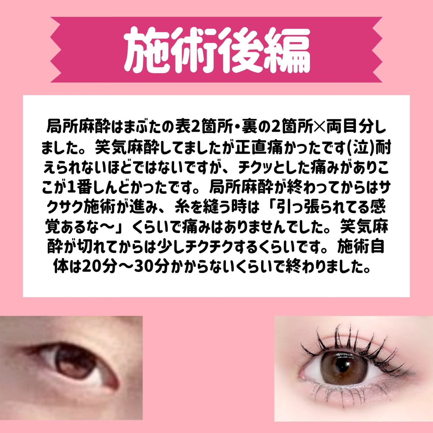 五月@正直レビュー on LIPS 「【水の森で二重埋没した結果📖】カウンセリング予約~術後まで全て..」(8枚目)