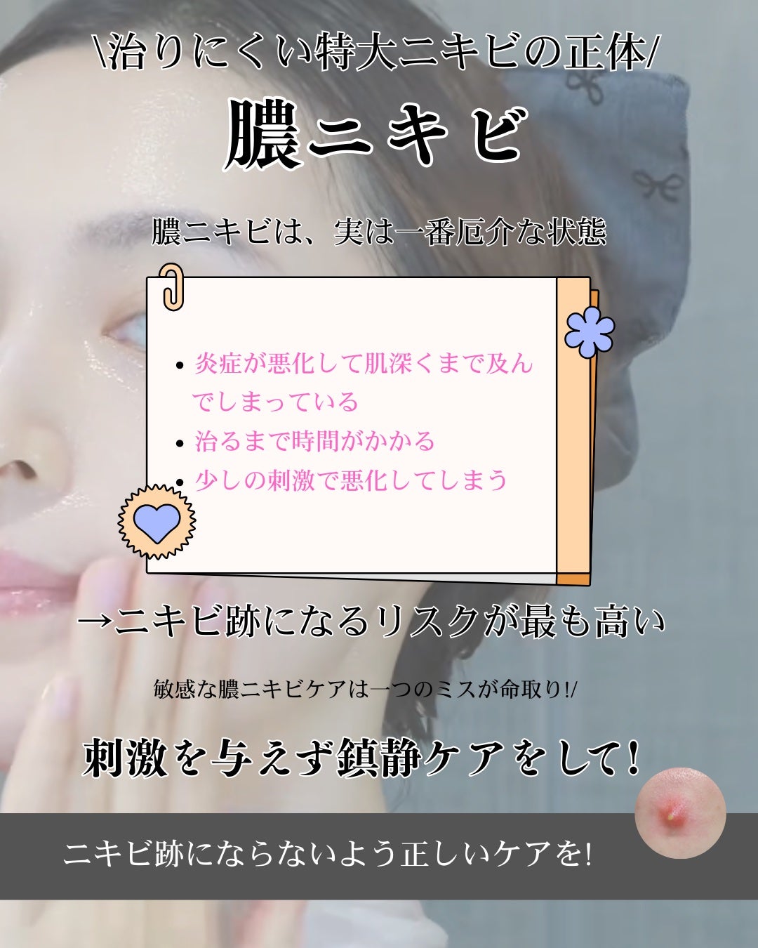 肌レポ編集室 on LIPS 「パンみたいに膨らんだ“特大ニキビ”。正直、ああいうタイプって放..」(2枚目)