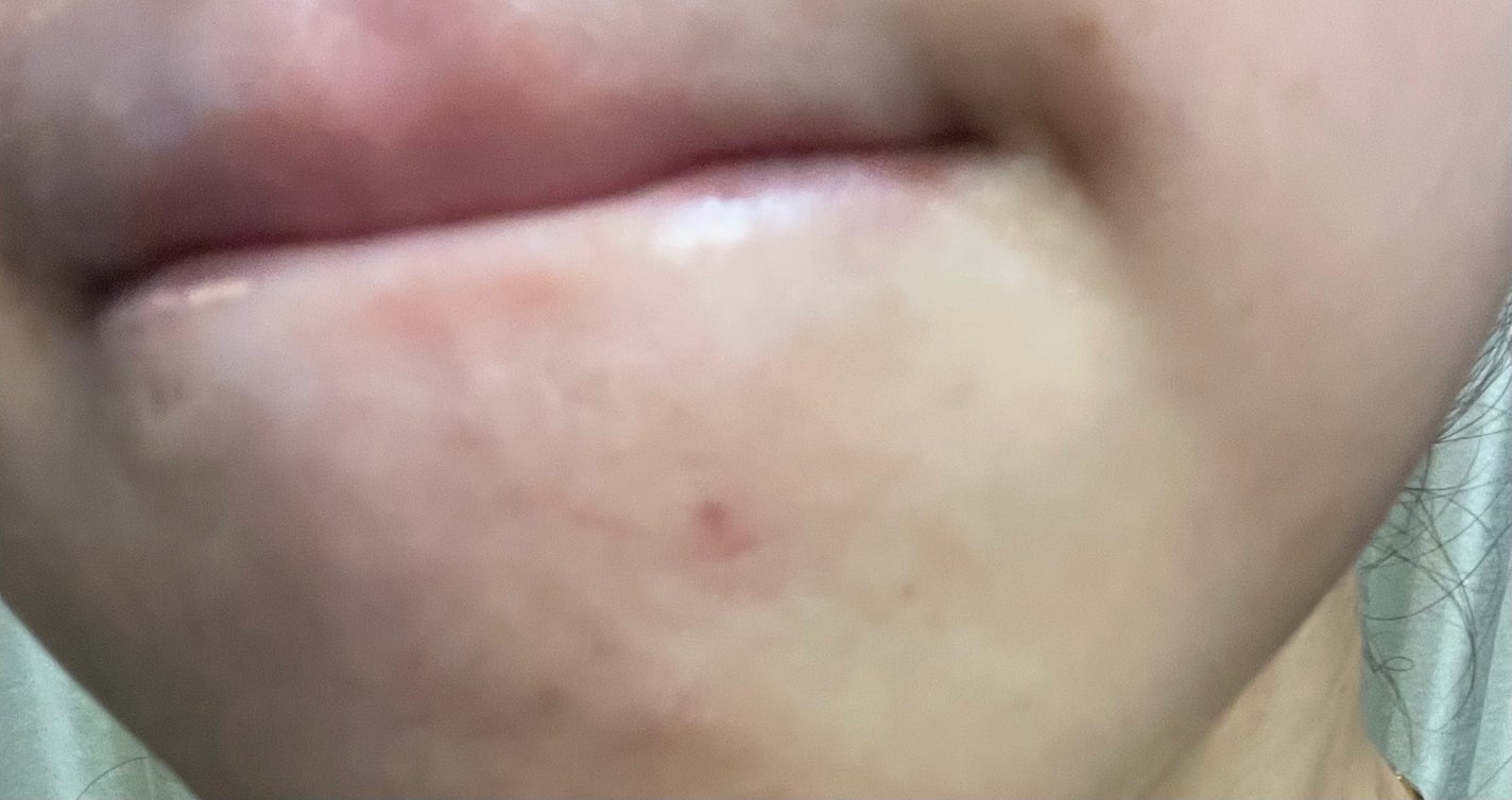 RXザ・アルファアルブチン2 ニキビ跡ケアセラム/COSRX/美容液を使ったクチコミ(6枚目)