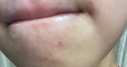 RXザ・アルファアルブチン2 ニキビ跡ケアセラム/COSRX/美容液を使ったクチコミ(6枚目)