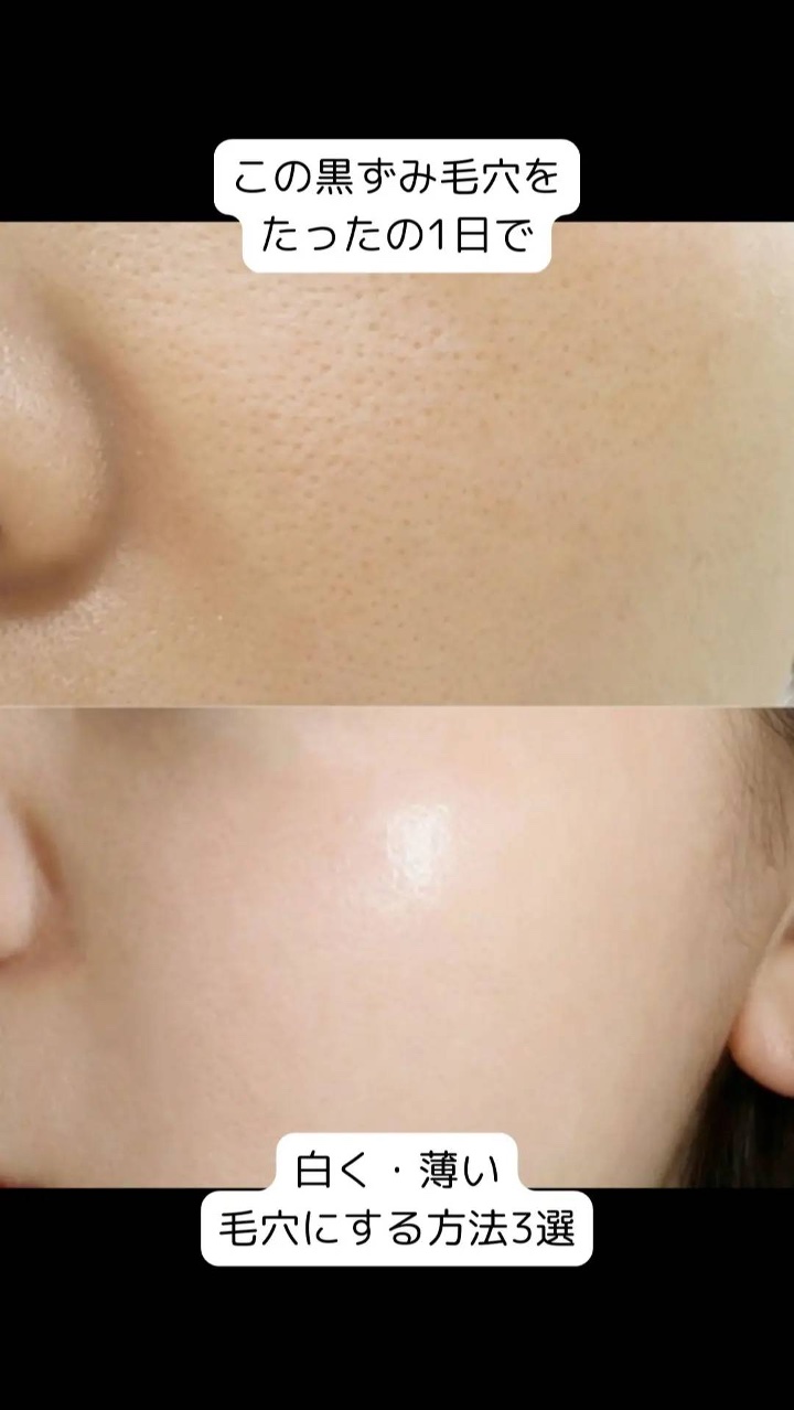 アネトス アクネケア トリートメント セラム/Anetos/美容液を使ったクチコミ（1枚目）