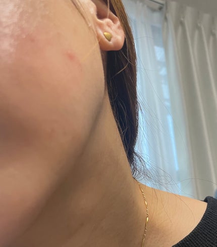 RXザ・アルファアルブチン2 ニキビ跡ケアセラム/COSRX/美容液を使ったクチコミ(4枚目)