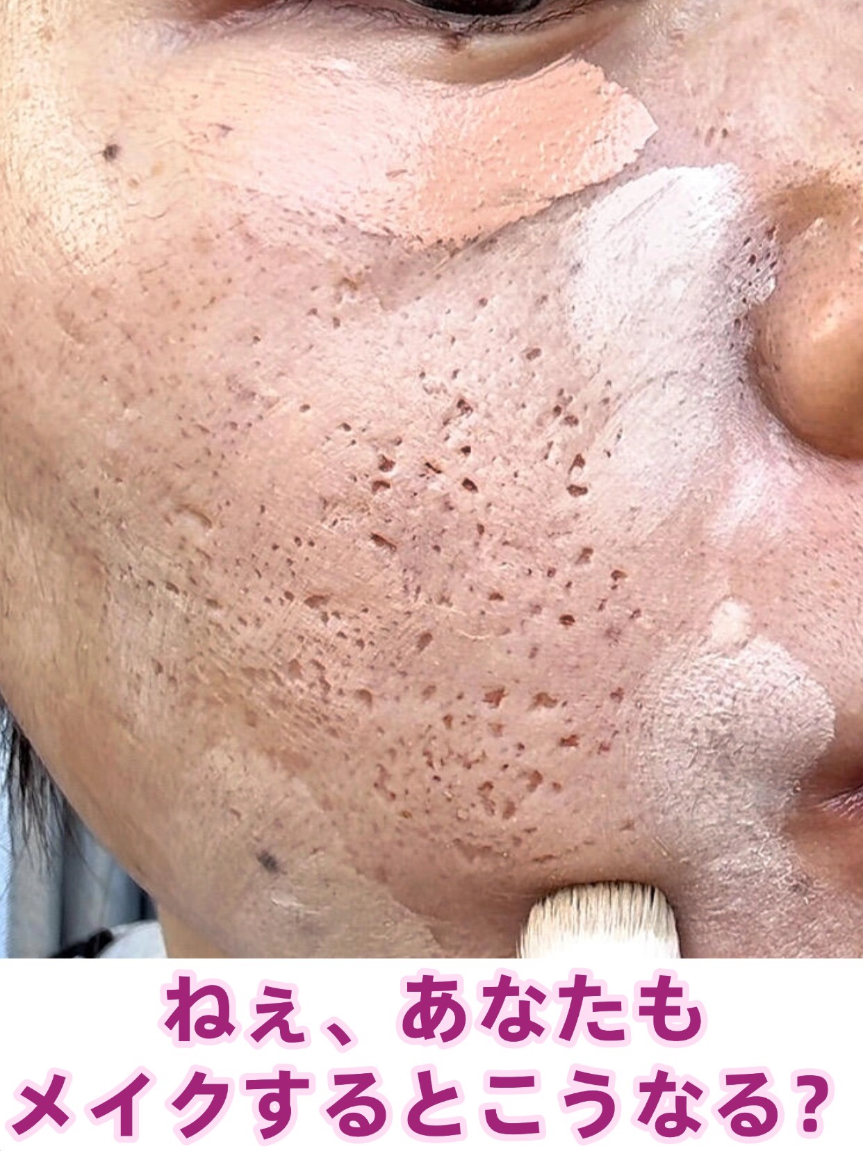 アネトス アクネケア トリートメント セラム/Anetos/美容液を使ったクチコミ（1枚目）