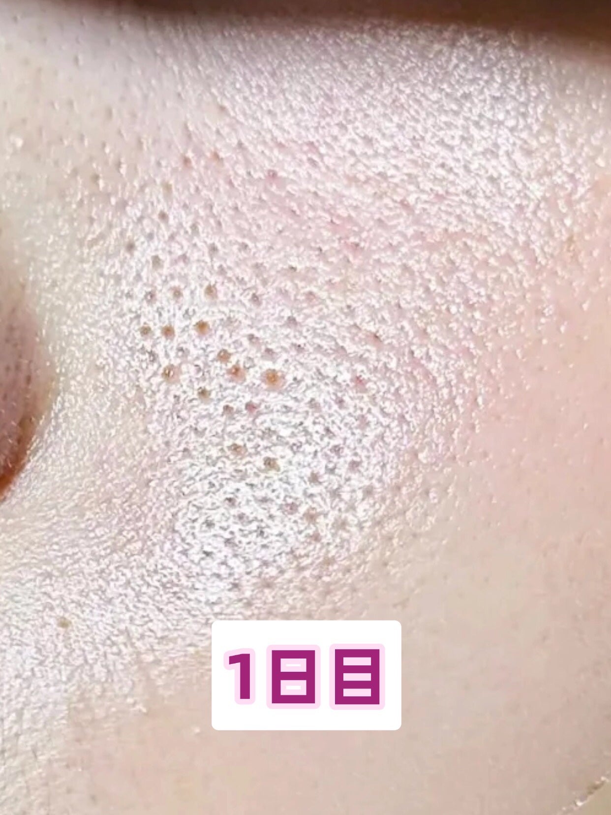 アネトス アクネケア トリートメント セラム/Anetos/美容液を使ったクチコミ(5枚目)