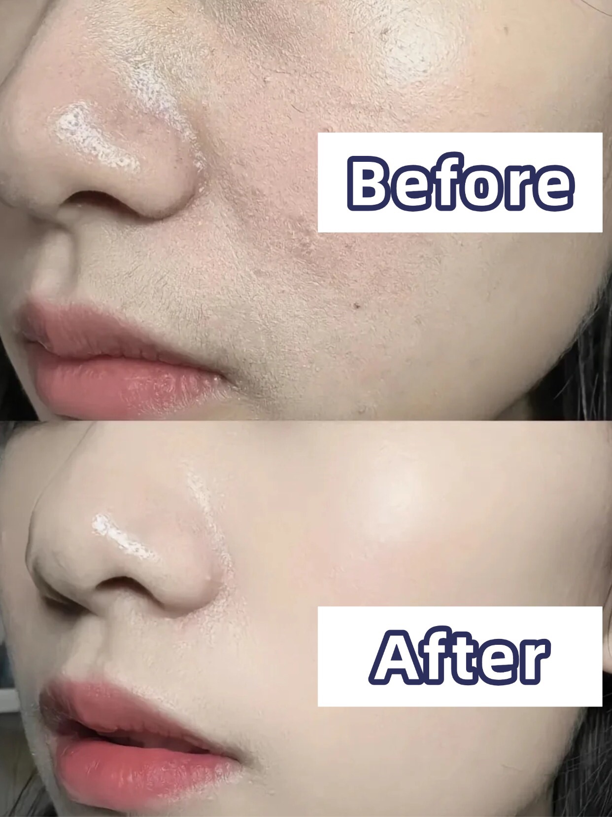 アネトス アクネケア トリートメント セラム/Anetos/美容液を使ったクチコミ（1枚目）