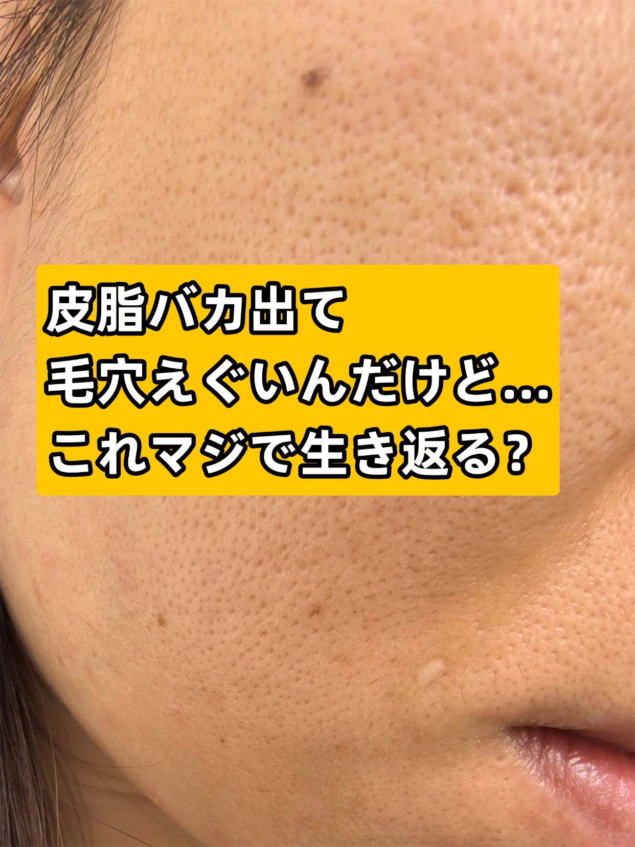 アネトス アクネケア トリートメント セラム/Anetos/美容液を使ったクチコミ（2枚目）