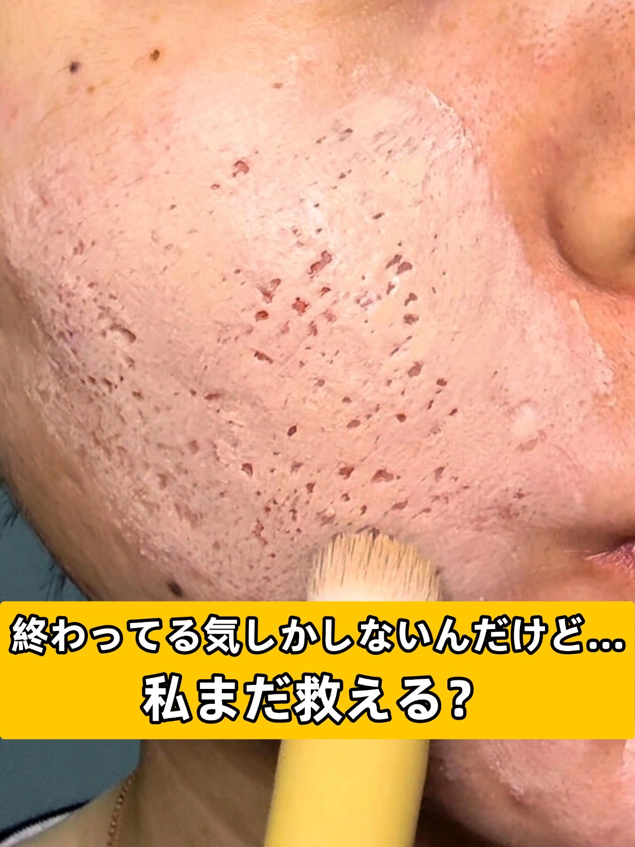 アネトス アクネケア トリートメント セラム/Anetos/美容液を使ったクチコミ（1枚目）