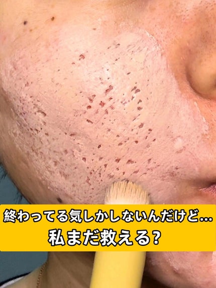 アネトス アクネケア トリートメント セラム/Anetos/美容液を使ったクチコミ(1枚目)