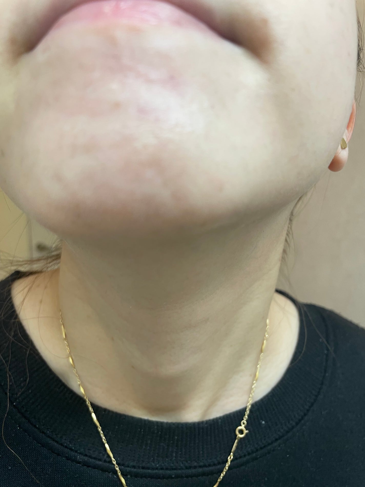 RXザ・アルファアルブチン2 ニキビ跡ケアセラム/COSRX/美容液を使ったクチコミ(7枚目)