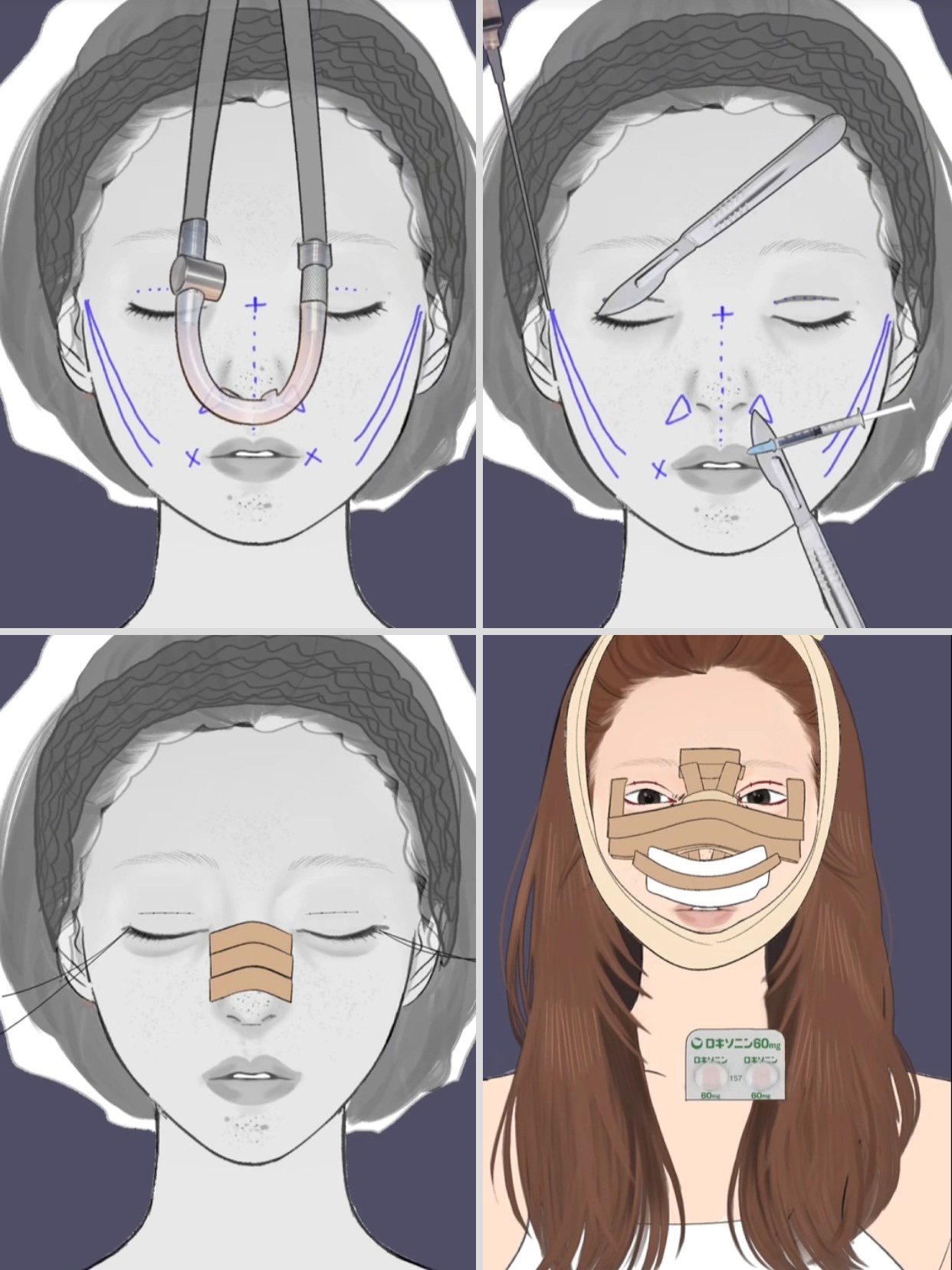 アネトス アクネケア トリートメント セラム/Anetos/美容液を使ったクチコミ（2枚目）