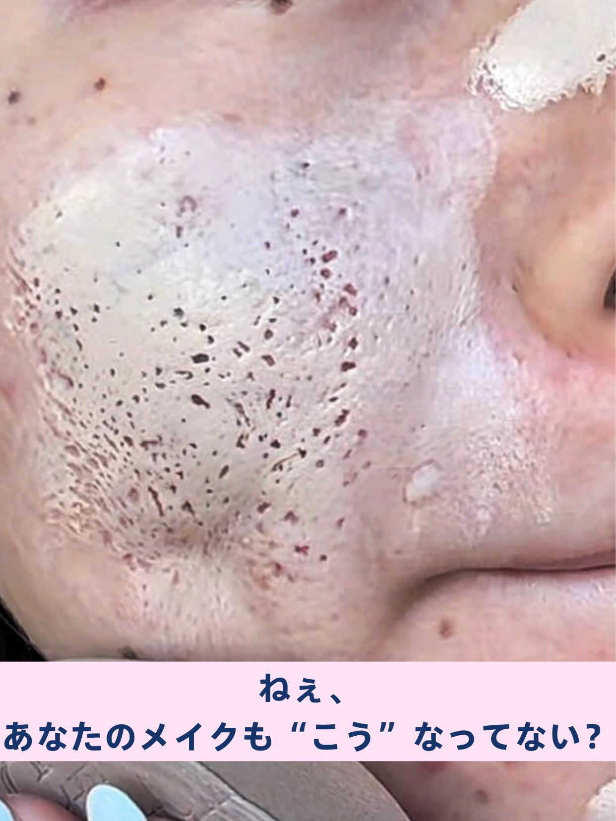 アネトス アクネケア トリートメント セラム/Anetos/美容液を使ったクチコミ(1枚目)