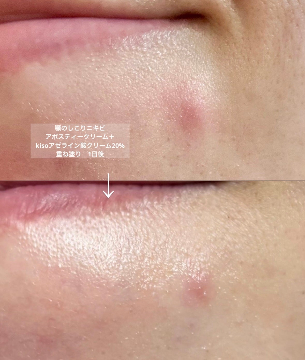 アポスティークリーム(医薬品)/アポスティー/その他を使ったクチコミ(2枚目)