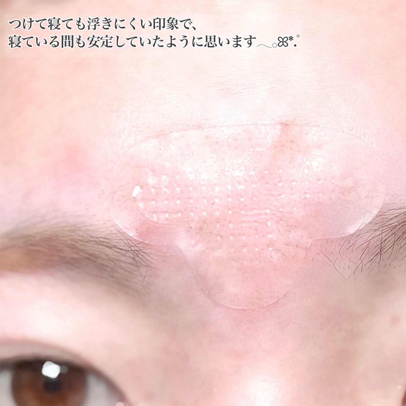 レチアールエヌ Tパッチ/ACROPASS/シートマスク・パックを使ったクチコミ(5枚目)