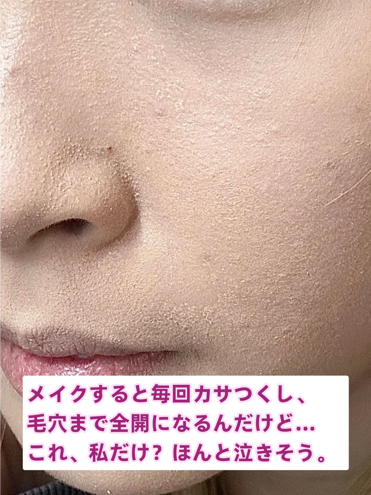 アネトス アクネケア トリートメント セラム/Anetos/美容液を使ったクチコミ（2枚目）