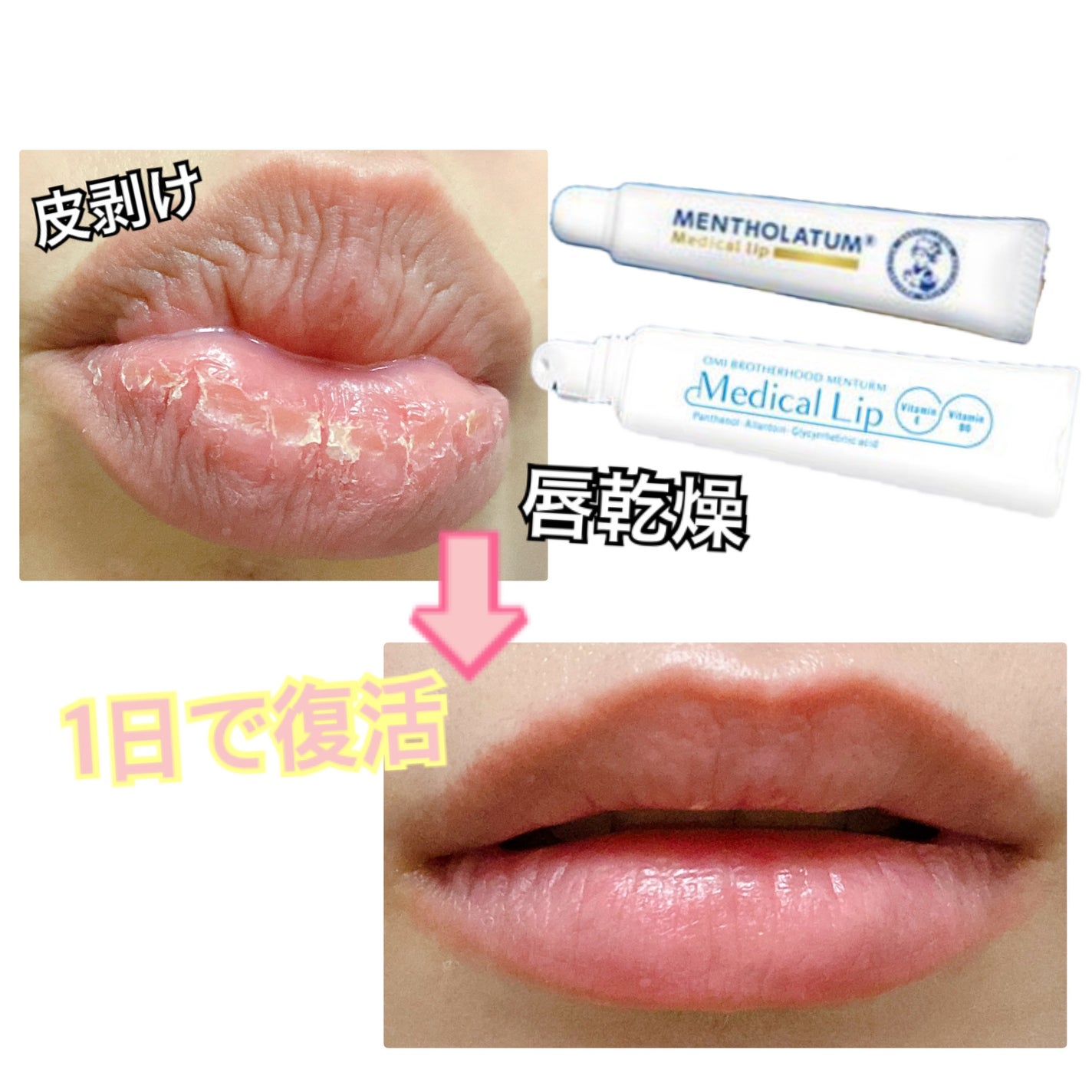 メディカルリップnc(医薬品)/メンソレータム/その他を使ったクチコミ(1枚目)