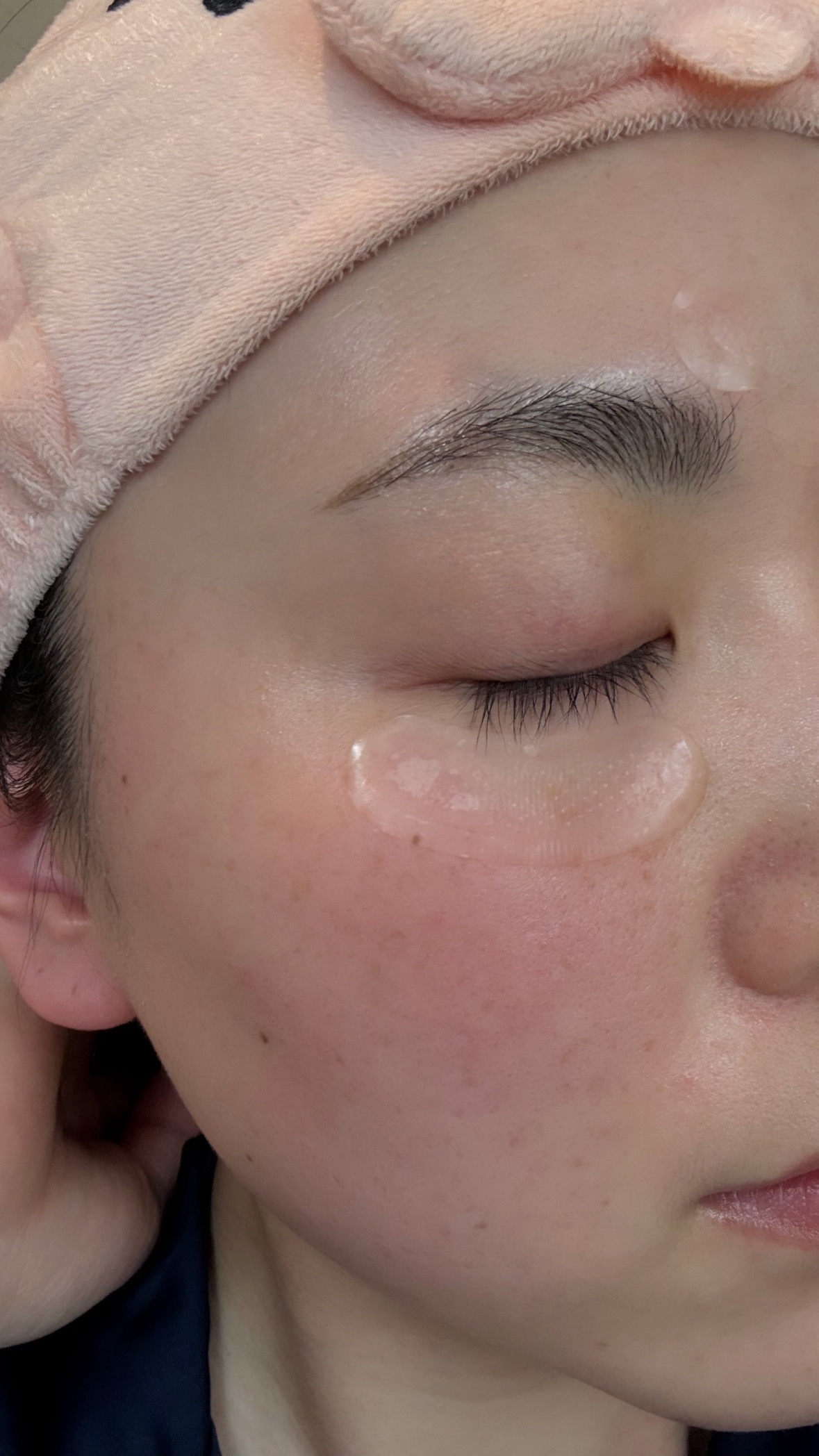 レチアールエヌ スリムパッチ/ACROPASS/シートマスク・パックを使ったクチコミ（2枚目）