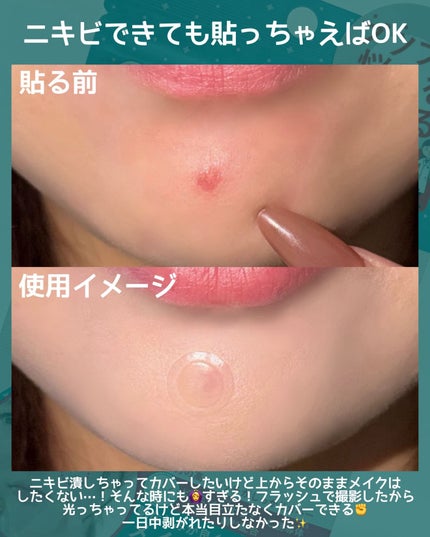 ゼロスポットパッチ/Today’s Cosme/にきびパッチを使ったクチコミ(4枚目)