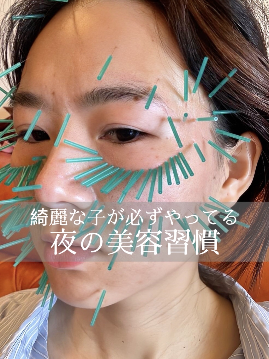 アネトス アクネケア トリートメント セラム/Anetos/美容液を使ったクチコミ（1枚目）