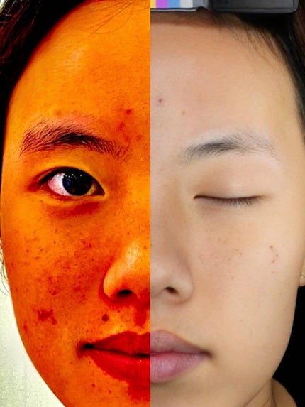 アネトス アクネケア トリートメント セラム/Anetos/美容液を使ったクチコミ(2枚目)