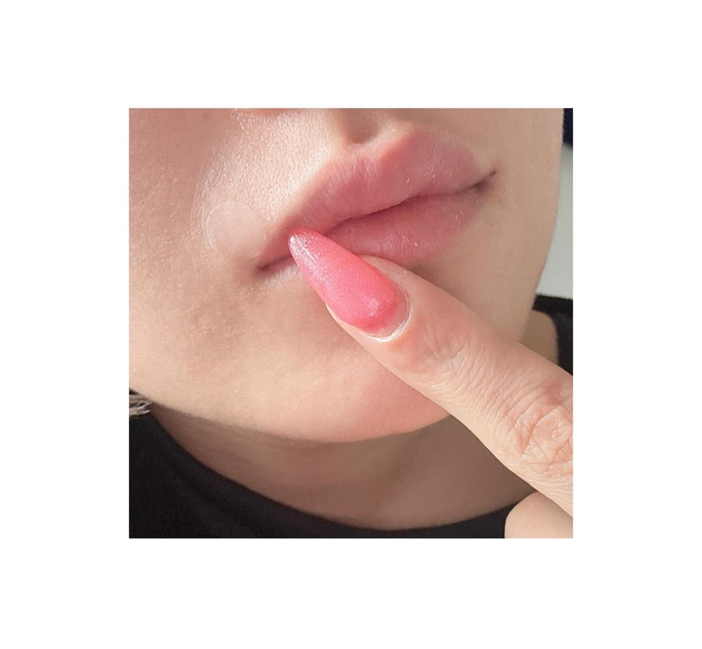 ニキパ! プレミアム 極薄透明パッチ/金冠堂/にきびパッチを使ったクチコミ（2枚目）