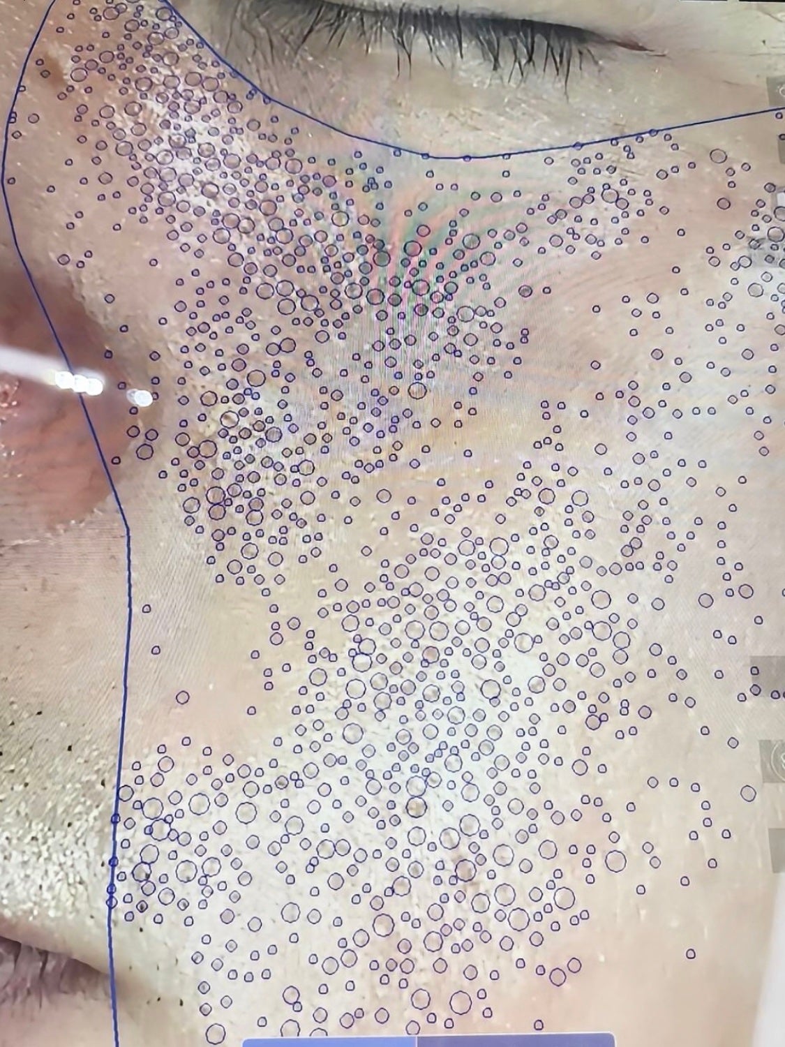 アネトス アクネケア トリートメント セラム/Anetos/美容液を使ったクチコミ(3枚目)