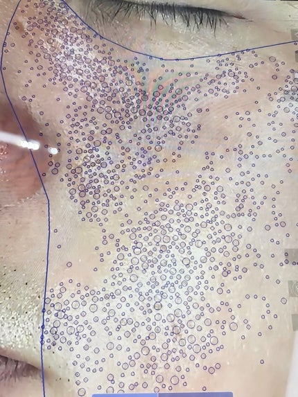 アネトス アクネケア トリートメント セラム/Anetos/美容液を使ったクチコミ(3枚目)