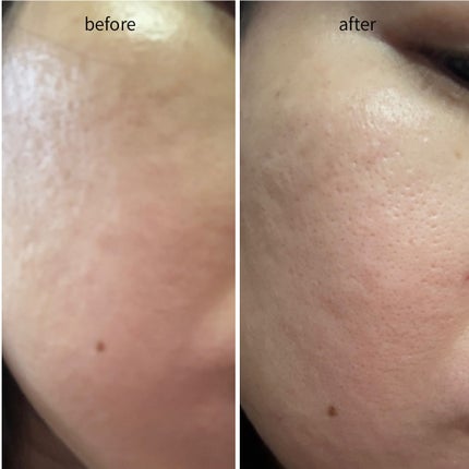 リードルショット100/VT/美容液を使ったクチコミ(4枚目)