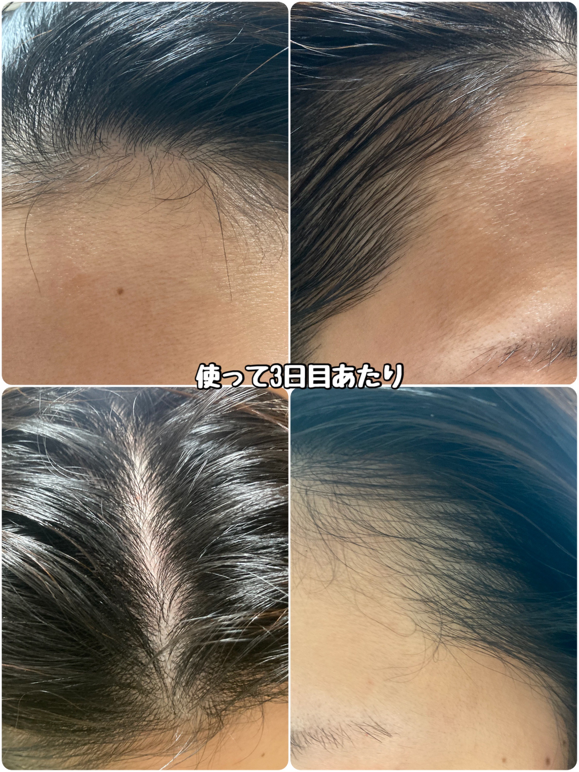 グローターンヘアアンプル/リリーイブ/頭皮ローションを使ったクチコミ（3枚目）