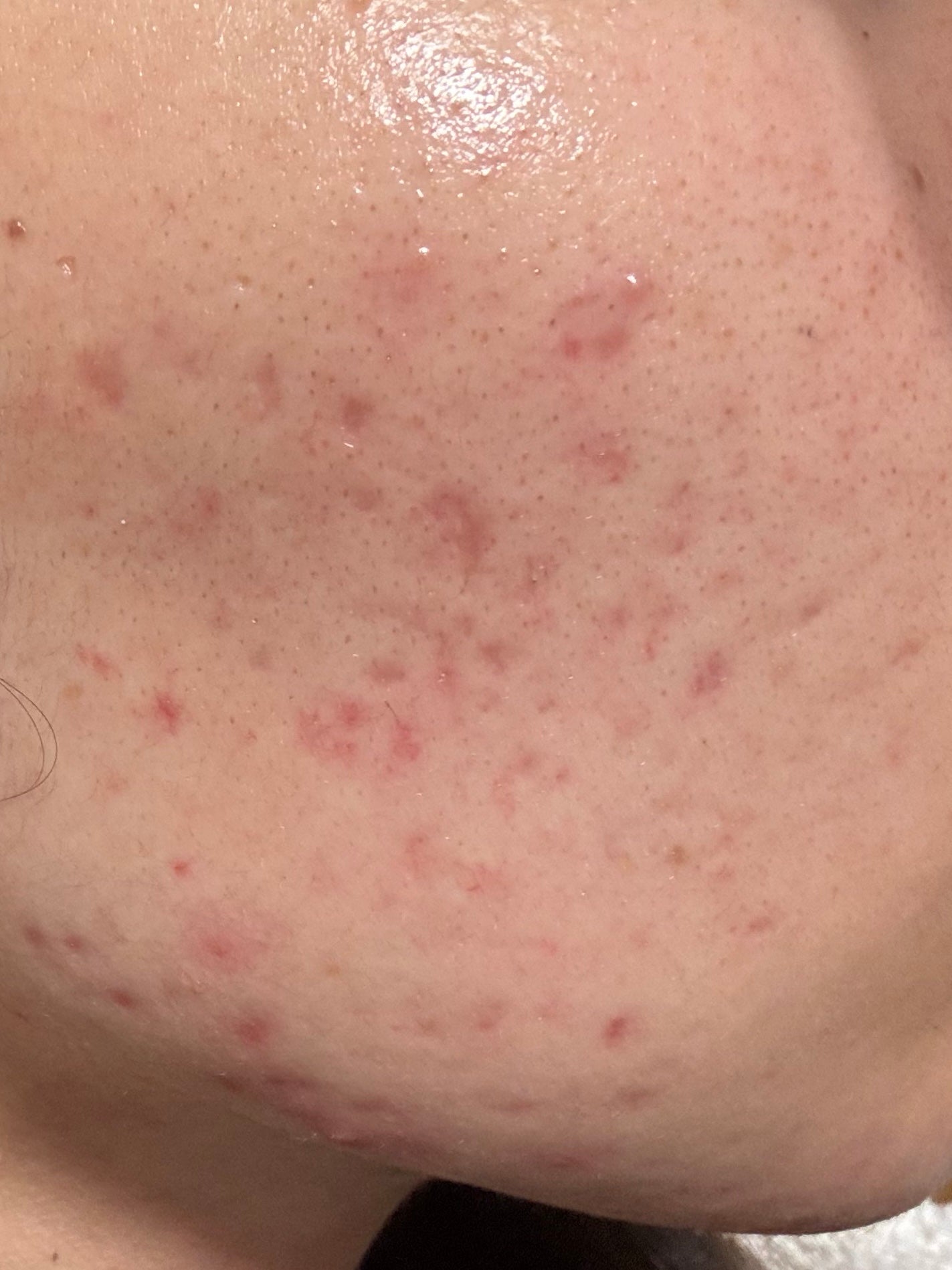 ペアアクネクリームW(医薬品)/ペア/その他を使ったクチコミ(1枚目)