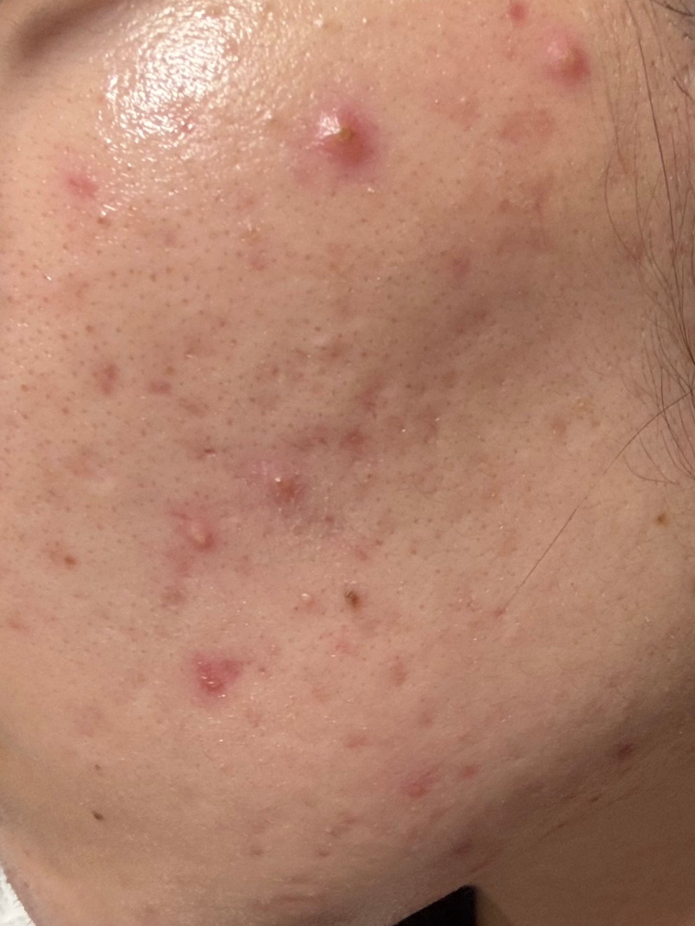 ペアアクネクリームW(医薬品)/ペア/その他を使ったクチコミ(2枚目)