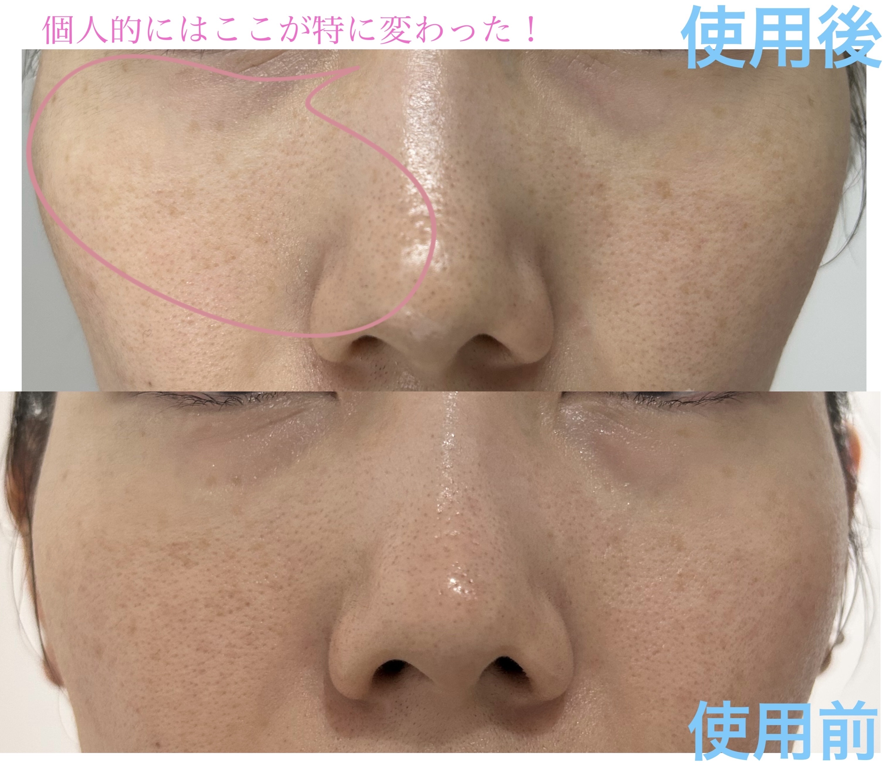 メララピールプログラム/Easydew/その他スキンケアを使ったクチコミ（1枚目）