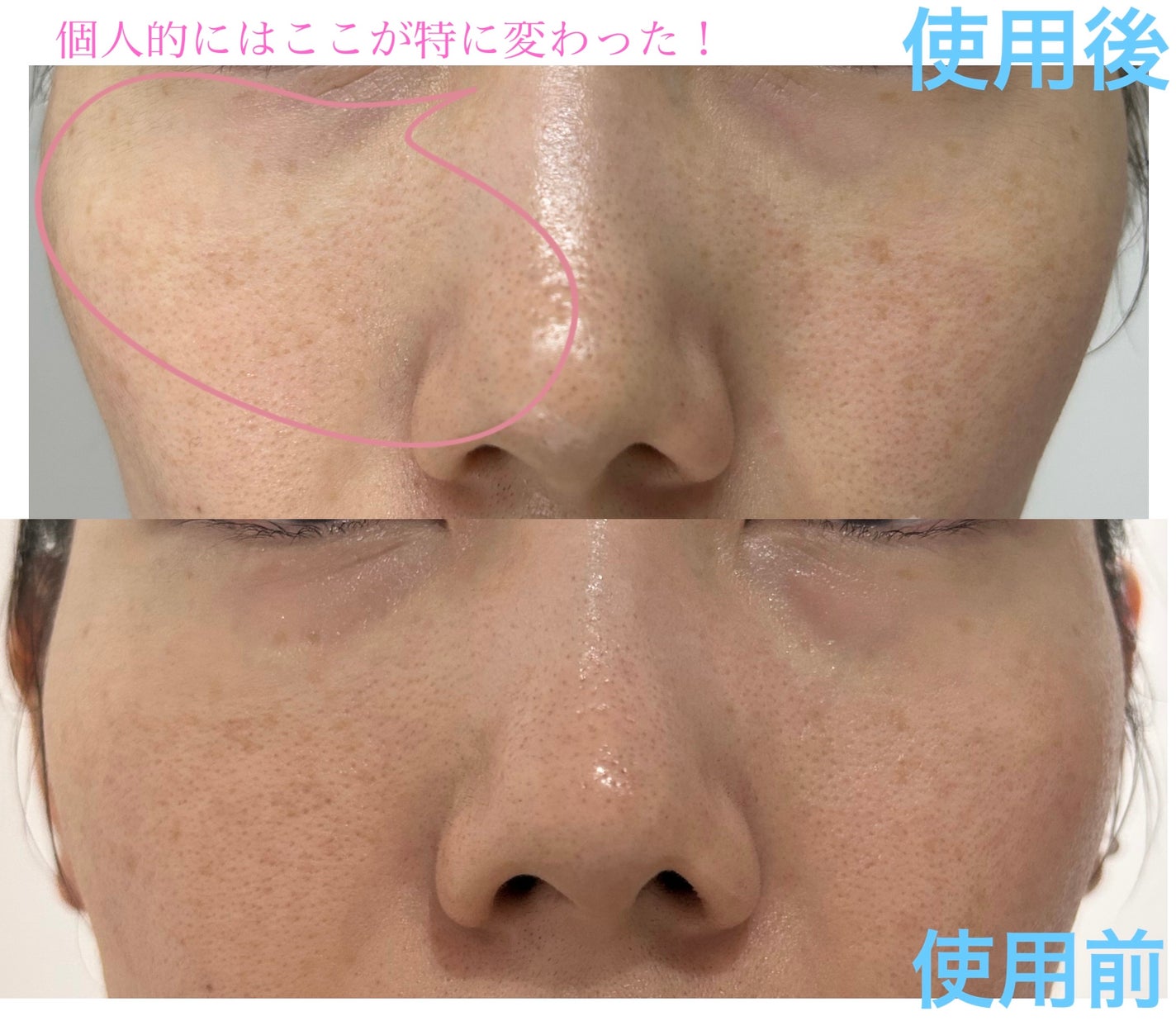 メララピールプログラム/Easydew/その他スキンケアを使ったクチコミ(1枚目)