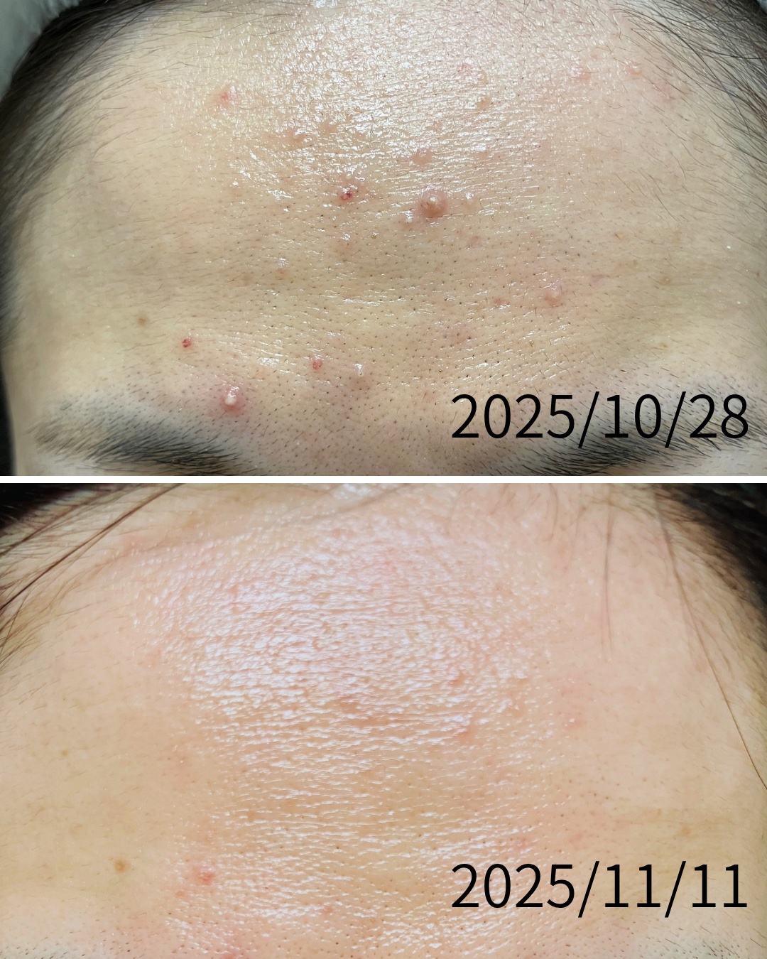 【記録用】

ニキビに悩んで悩んで、悩みすぎて
禿げるかと思った
この1ヵ月半…。
なんか、ようやく治ってきた気がする🥹✨

この1ヵ月半、
・泡洗顔をゴシゴシせず優しく徹底
・ぬるま湯ですすぐの30回ルール
・化粧水とクリームを塗りたく