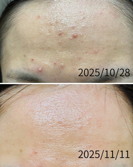 ぼぶ on LIPS 「【記録用】ニキビに悩んで悩んで、悩みすぎて禿げるかと思ったこの..」(1枚目)