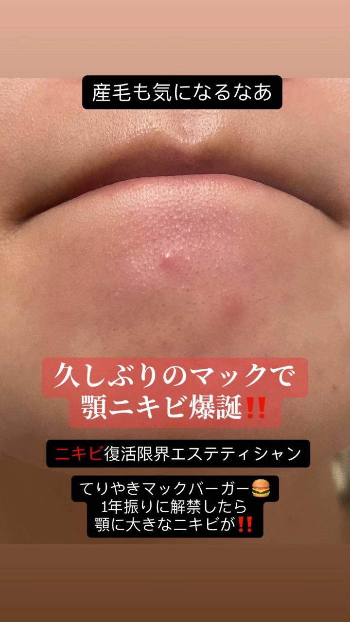 アネトス アクネケア トリートメント セラム/Anetos/美容液を使ったクチコミ(1枚目)