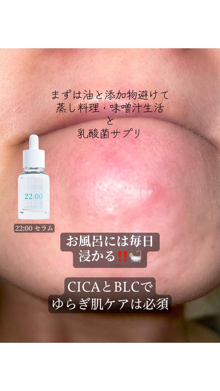 アネトス アクネケア トリートメント セラム/Anetos/美容液を使ったクチコミ（3枚目）