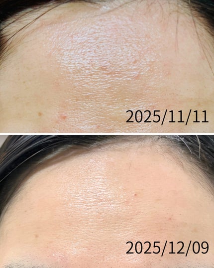 ぼぶ on LIPS 「【記録用】ニキビに悩んで悩んで、悩みすぎて禿げるかと思ったこの..」(2枚目)