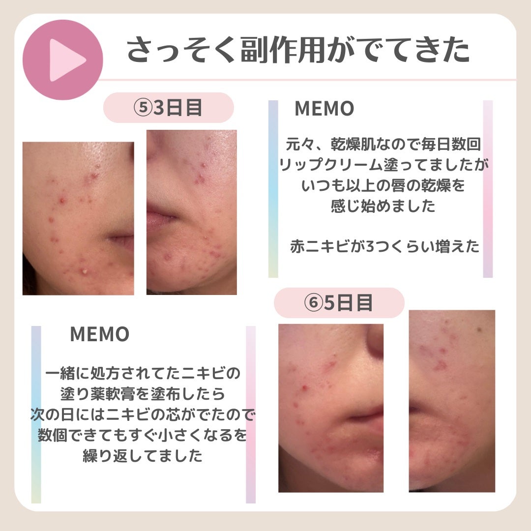 ななさん(肌年齢-8歳)フォロバします♡ on LIPS 「【8年間ニキビ・ニキビ跡との闘い】ニキビ治療の最後の砦 イソト..」(8枚目)