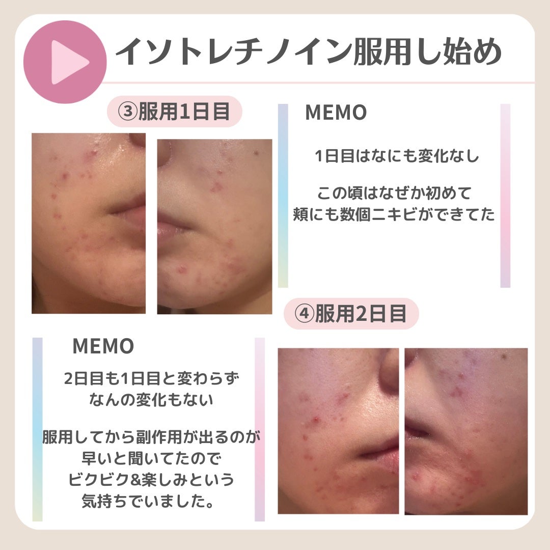 ななさん(肌年齢-8歳)フォロバします♡ on LIPS 「【8年間ニキビ・ニキビ跡との闘い】ニキビ治療の最後の砦 イソト..」(7枚目)