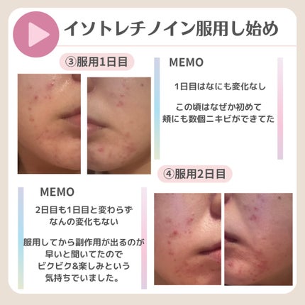 ななさん(肌年齢-8歳)フォロバします♡ on LIPS 「【8年間ニキビ・ニキビ跡との闘い】ニキビ治療の最後の砦 イソト..」(7枚目)