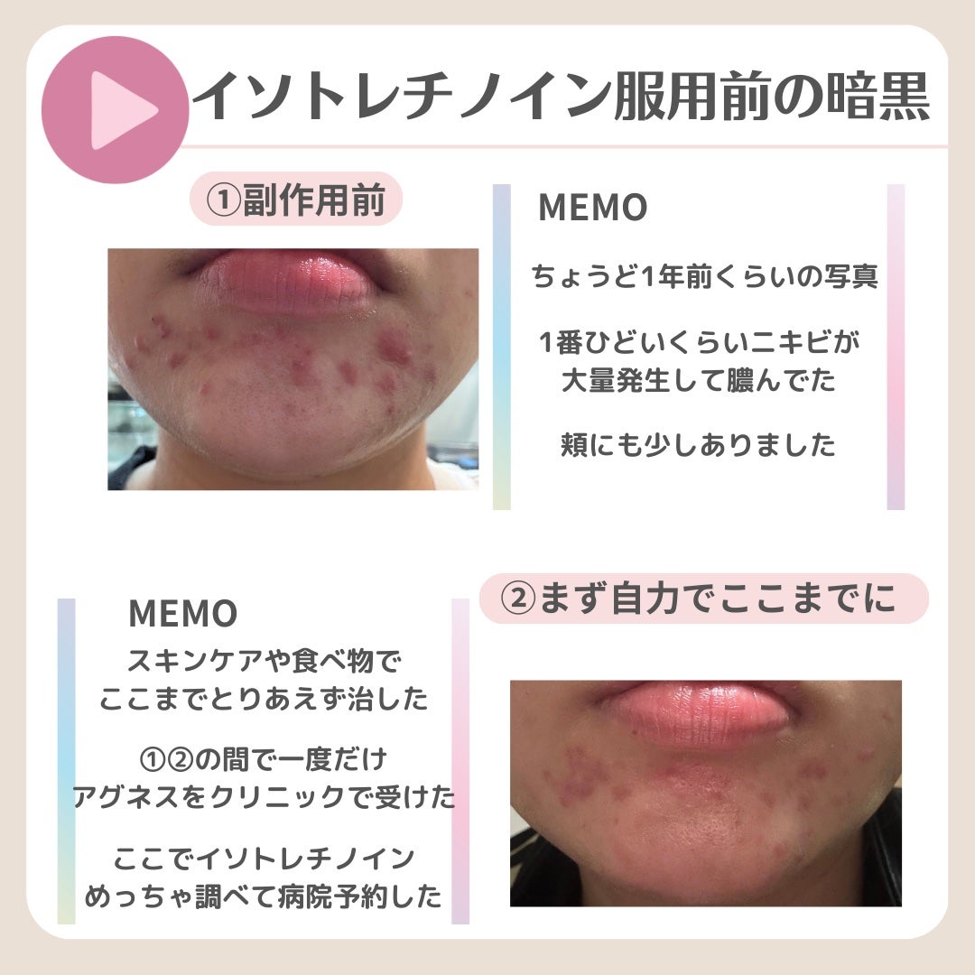 ななさん(肌年齢-8歳)フォロバします♡ on LIPS 「【8年間ニキビ・ニキビ跡との闘い】ニキビ治療の最後の砦 イソト..」(6枚目)