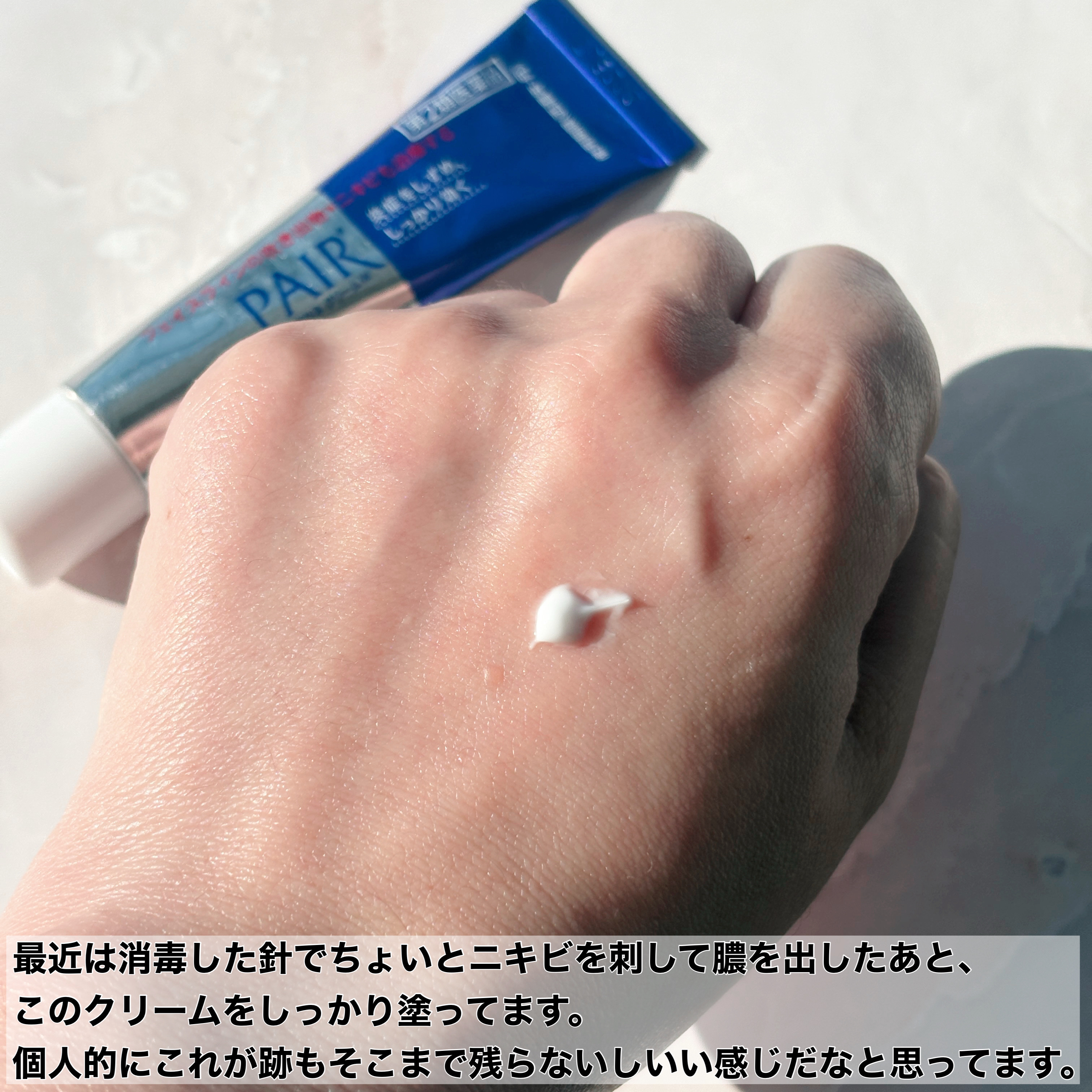 ペアアクネクリームW(医薬品)/ペア/その他を使ったクチコミ（2枚目）