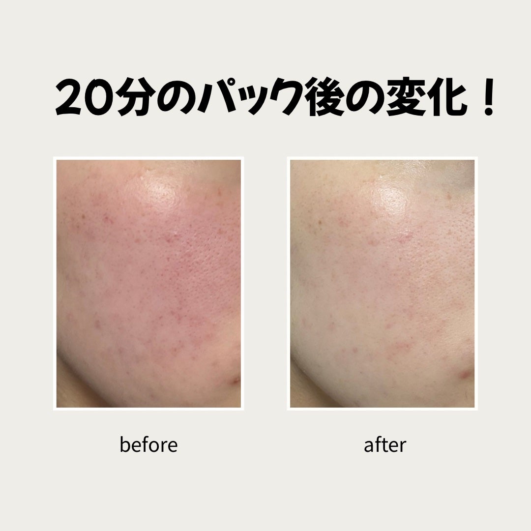 パーフェクト リアル パフォーマンス シカコラーゲンマスクパック /ダーマフィックス/シートマスク・パックを使ったクチコミ(3枚目)