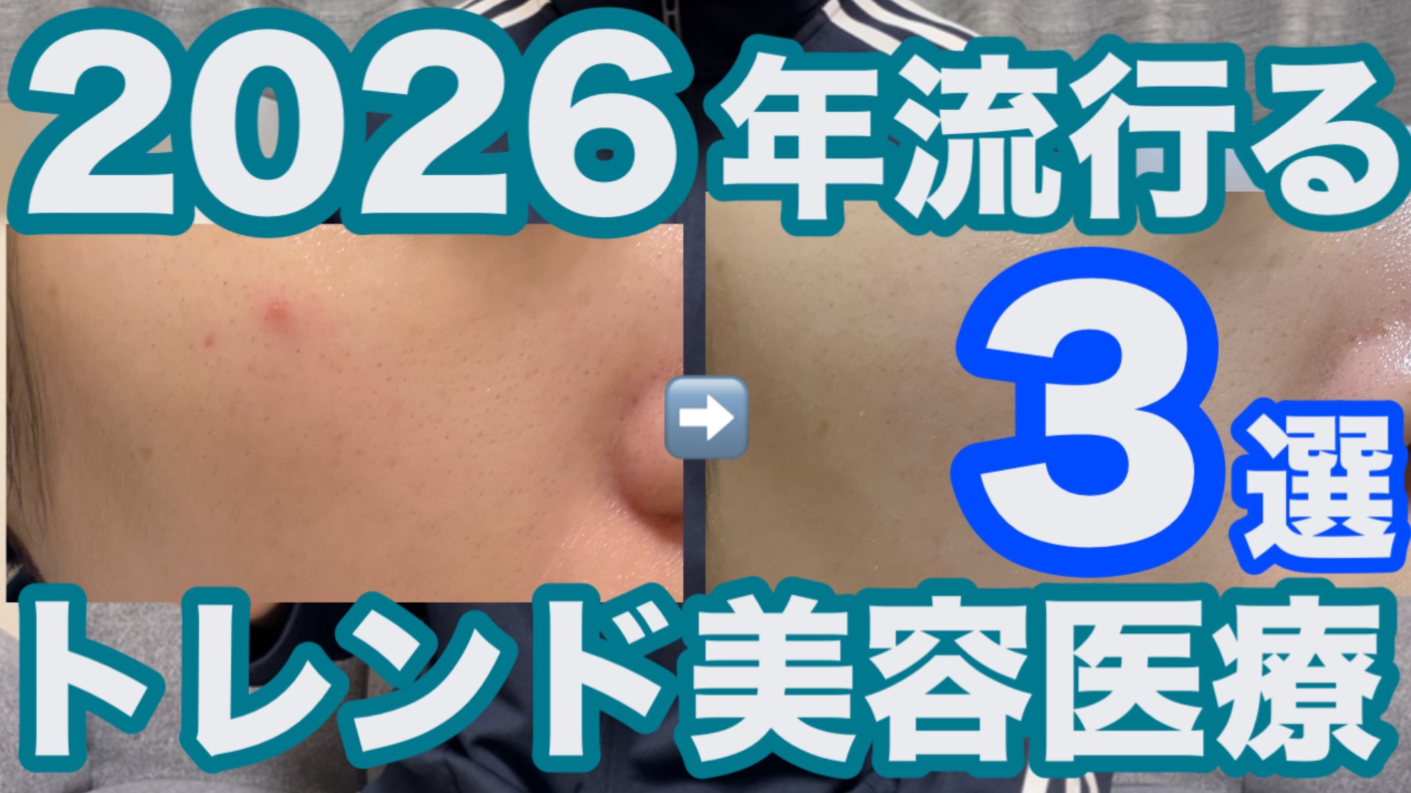 今日の19時公開のYouTube🐰

#美容医療 #美容皮膚科 #スキンケア #肌荒れ #ニキビ #毛穴 