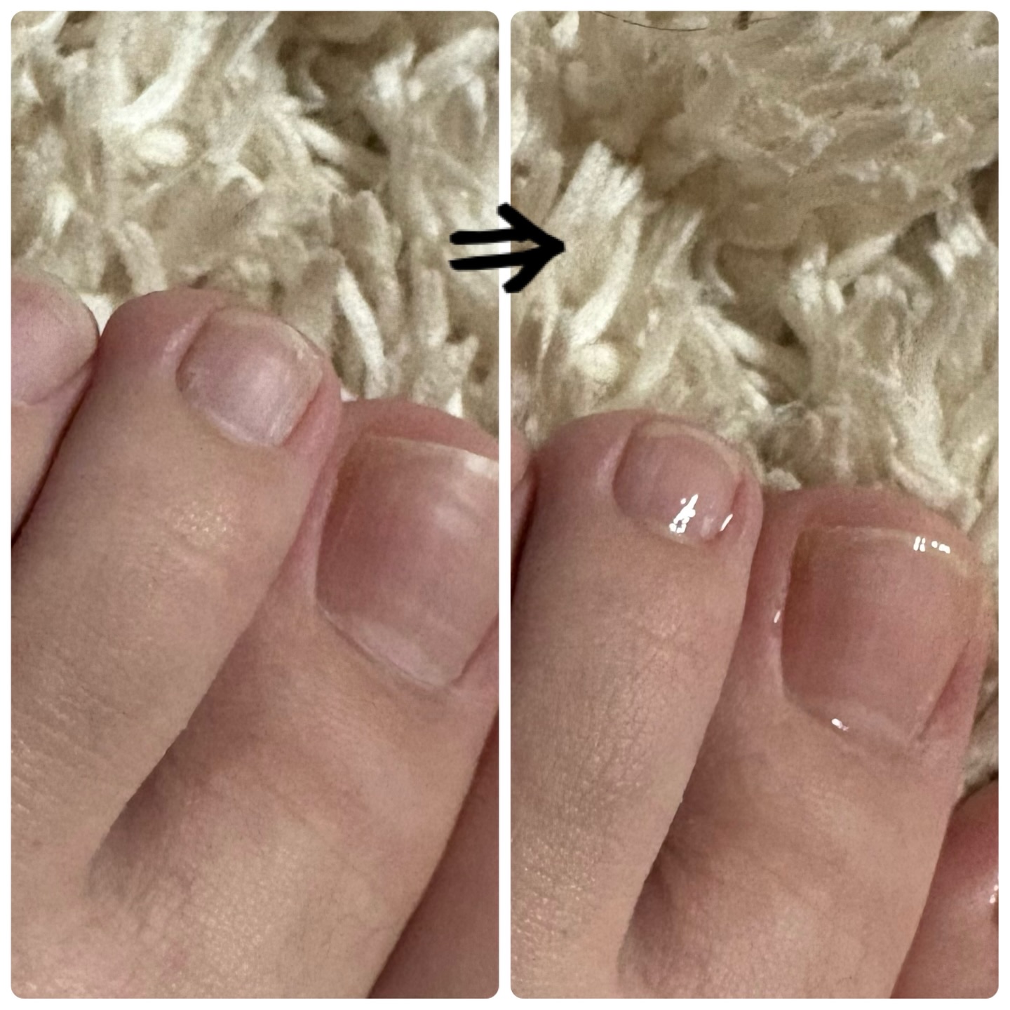 ベビーフット 足爪プロティンパック/ベビーフット/レッグ・フットケアを使ったクチコミ（2枚目）