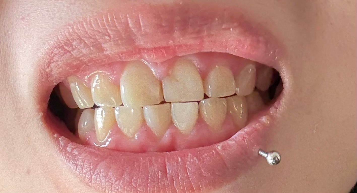 ハム太郎 on LIPS 「Liveoralsホワイトニングジェル少し白くなったかも..」(2枚目)